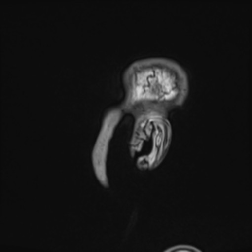 File:Colloid cyst of the third ventricle (Radiopaedia 86571-102662 Sagittal T1 2).png