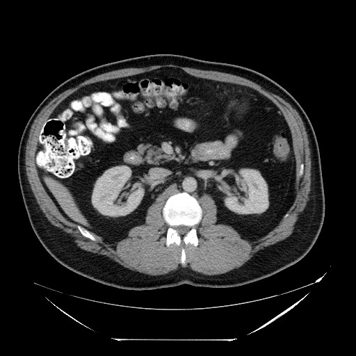 File:Colocolic intussusception due to lipoma (Radiopaedia 73712-84508 Axial 22).jpg