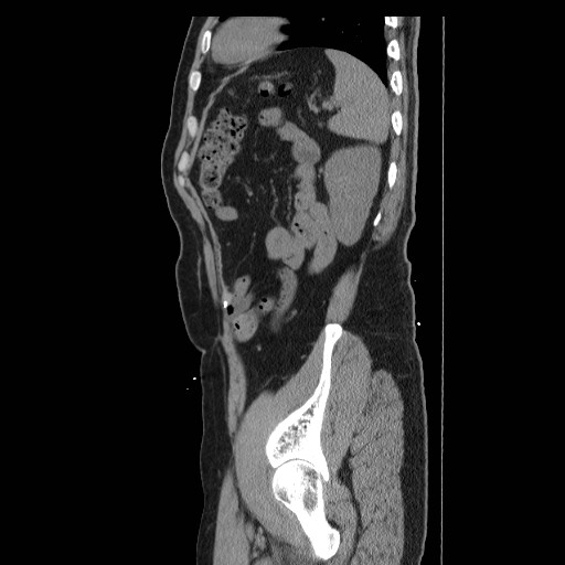 File:Colocutaneous fistula in Crohn's disease (Radiopaedia 29586-30093 C 51).jpg