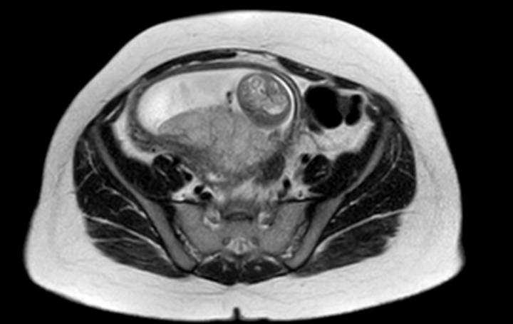 File:Colon adenocarcinoma with Krukenberg tumors, advanced pregnancy (Radiopaedia 67279-76645 Axial T2 22).jpg