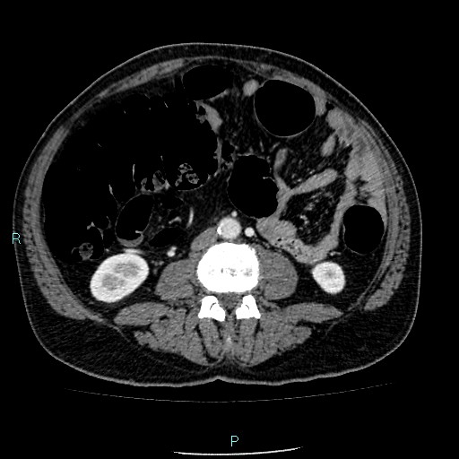 Colon adenocarcinoma with calcific liver metastasis (Radiopaedia 55745-62300 B 24).jpg