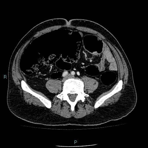 Colon adenocarcinoma with calcific liver metastasis (Radiopaedia 55745-62300 B 29).jpg