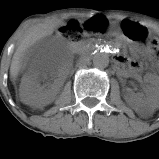 Colon cancer with calcified liver metastasis (Radiopaedia 74423-85309 Axial non-contrast 41).jpg
