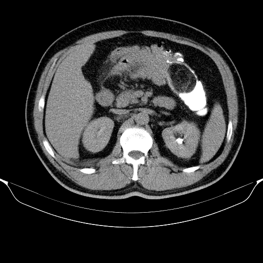 File:Colonic lipoma with colo-colic intussusception (Radiopaedia 58944-66200 Axial C+ rectal 18).jpg