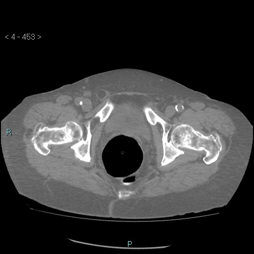 Colonic lipomas (Radiopaedia 49137-54244 Axial bone window 201).jpg