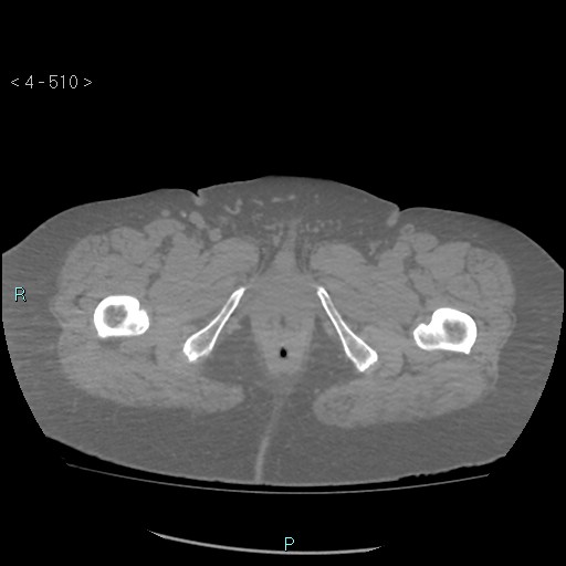 Colonic lipomas (Radiopaedia 49137-54244 Axial bone window 228).jpg
