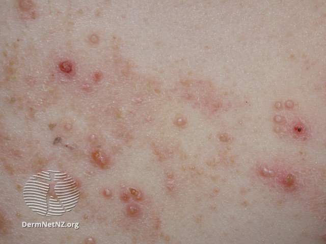 File:Eczema and crusted lesions (DermNet NZ viral-moll-ecz).jpg