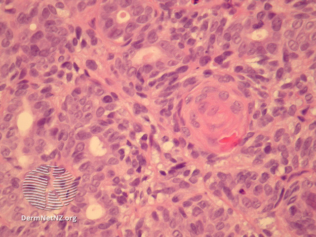 File:Figure 5 (DermNet NZ pathology-e-aggressive-adenocarcinoma-fig5).jpg