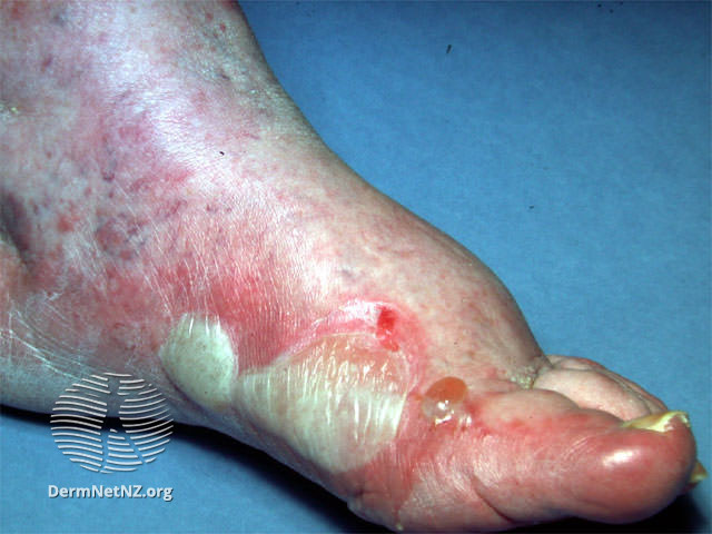 File:Foot dermatitis (DermNet NZ dermatitis-foot-neomycin).jpg