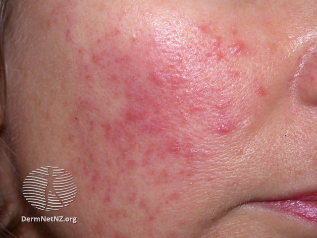 File:Mild papules and erythema (DermNet NZ acne-rosacea2).jpg