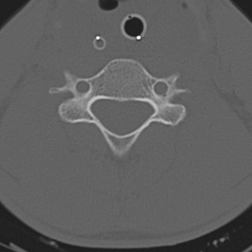 File:Multitrauma with diffuse axonal injury, temporal bone fractures and traumatic caroticocavernous fistula (Radiopaedia 37242-39035 Axial 167).png