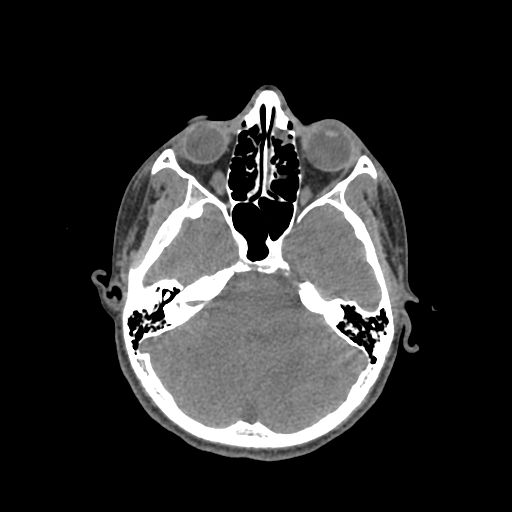 File:Nasal pyogenic granuloma (lobular capillary hemangioma) (Radiopaedia 85536-101244 Axial non-contrast 95).jpg
