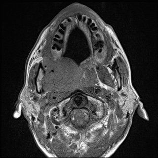 Nasopharyngeal carcinoma with skull base invasion (Radiopaedia 59258-66600 B 27).jpg