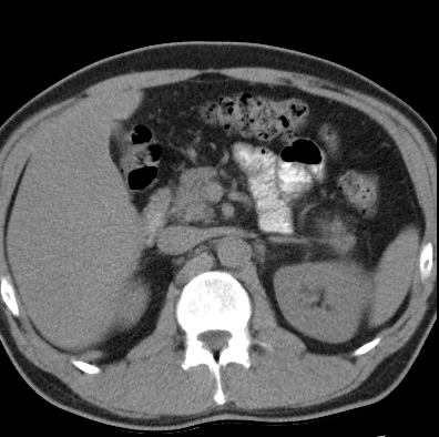 File:Necrotizing pancreatitis with acute necrotic collection (Radiopaedia 14470-14417 Axial non-contrast 13).jpg