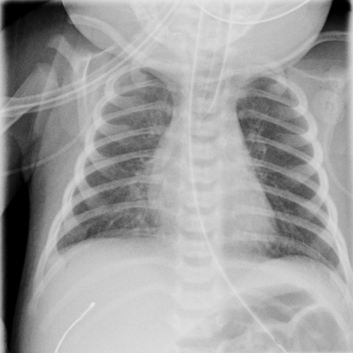 File:Neonatal pneumonia (Radiopaedia 23898-24086 Frontal 1).jpg