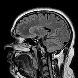 File:Neuro-Behcet's disease (Radiopaedia 21557-21506 Sagittal FLAIR 21).jpg