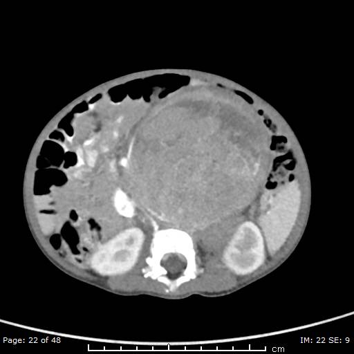 File:Neuroblastoma (Radiopaedia 41472-44355 A 22).jpg