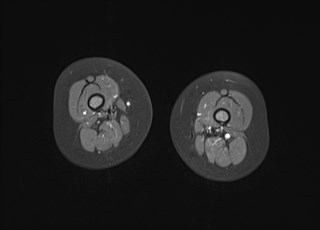 File:Neuroblastoma with bone metastases (Radiopaedia 67080-76414 Axial T1 C+ fat sat 22).jpg