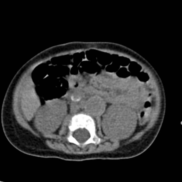 Neuroblastoma with skull metastases (Radiopaedia 30326-30960 Axial non-contrast 32).jpg