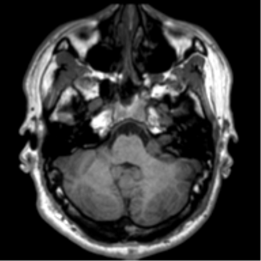 File:Neurofibromatosis type 2 (Radiopaedia 44936-48838 Axial T1 25).png