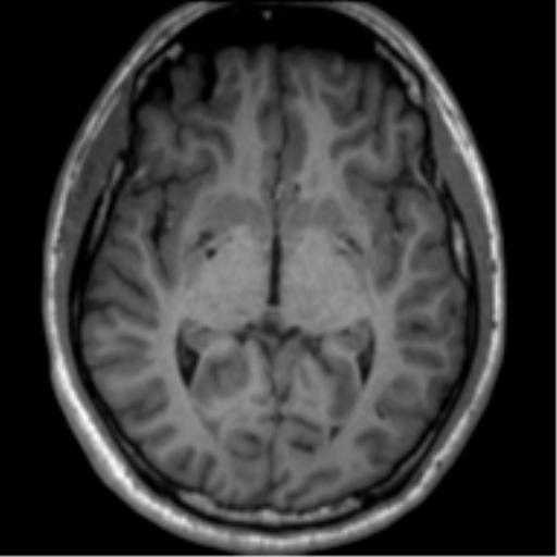 File:Neurofibromatosis type 2 (Radiopaedia 44936-48838 Axial T1 66).png