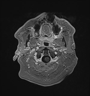 Neurofibromatosis type 2 (Radiopaedia 79097-92049 Axial T1 C+ 20).jpg