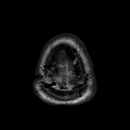 File:Neurofibromatosis type 2 (Radiopaedia 8713-9518 Axial T1 1).jpg