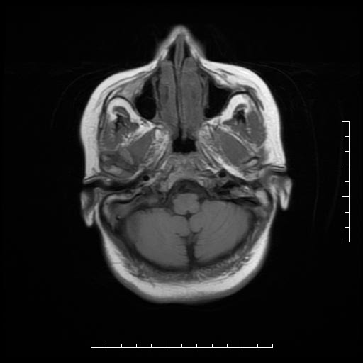 File:Neuroglial cyst of brainstem (Radiopaedia 29134-29526 Axial T1 3).jpg