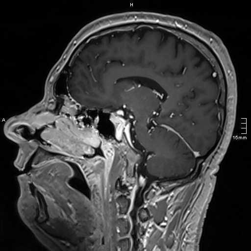 Neurosarcoidosis - involvement of the mesial temporal lobes (Radiopaedia 67429-76820 Sagittal T1 C+ 74).jpg