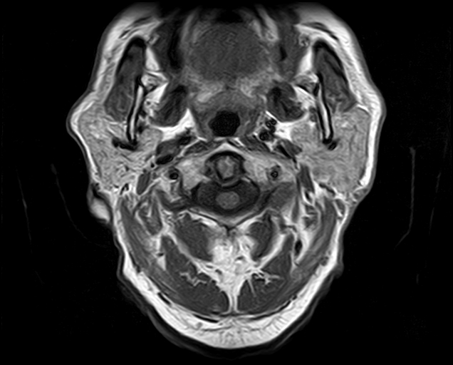 File:Non-Hodgkin lymphoma - parotid gland (Radiopaedia 71531-81890 Axial T1 15).jpg