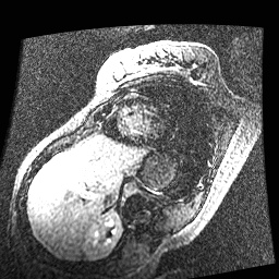 File:Non-compaction of the left ventricle (Radiopaedia 38868-41062 E 5).jpg