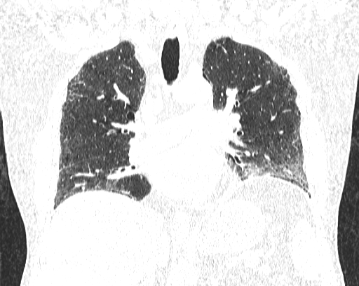 Non-specific interstitial pneumonia (NSIP) (Radiopaedia 68599-78228 Coronal lung window 48).jpg