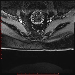 Non Hodgkin's lymphoma with metastasis to spine (Radiopaedia 54844-61103 Axial T1 C+ fat sat 52).jpg