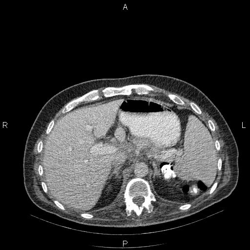 File:Non Hodgkin lymphoma in a patient with ankylosing spondylitis (Radiopaedia 84323-99624 B 29).jpg