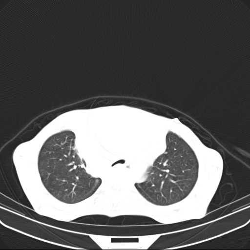 File:Non hodgkin lymphoma of the mediastinum (Radiopaedia 20814-20729 Axial lung window 16).jpg