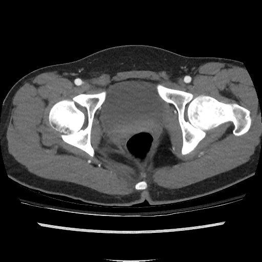 File:Normal CT angiogram of pelvis (Radiopaedia 45390-49430 A 48).jpg