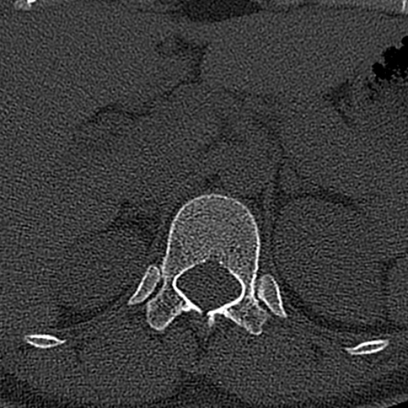 File:Normal CT lumbar spine (Radiopaedia 53981-60118 Axial bone window 2).jpg