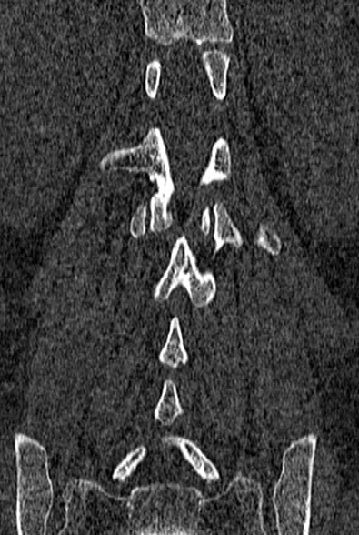 Normal CT lumbar spine (Radiopaedia 53981-60118 Coronal bone window 49).jpg