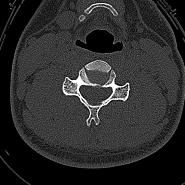 File:Normal CT of the cervical spine (Radiopaedia 53322-59305 Axial bone window 149).jpg