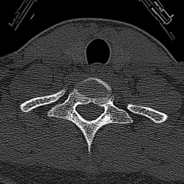 Normal CT of the cervical spine (Radiopaedia 53322-59305 Axial bone window 225).jpg