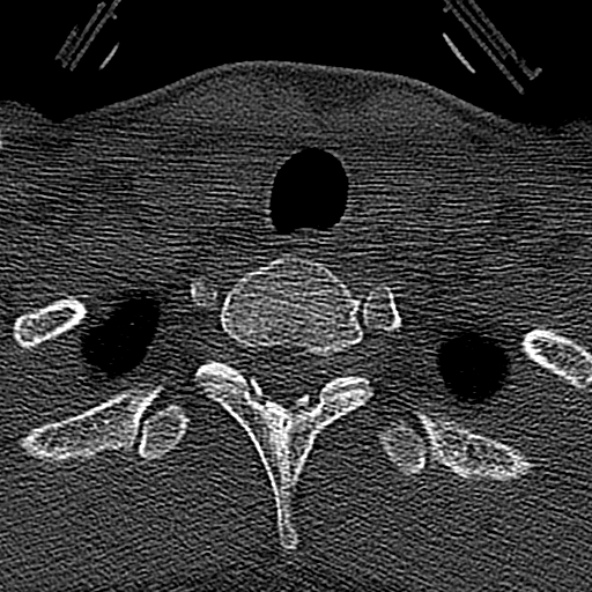 Normal CT of the cervical spine (Radiopaedia 53322-59305 Axial bone window 242).jpg
