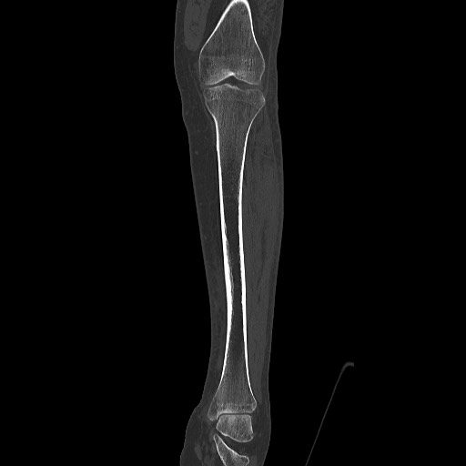 Normal CT tibia and fibula (Radiopaedia 51195-56848 Coronal non-contrast 31).jpg