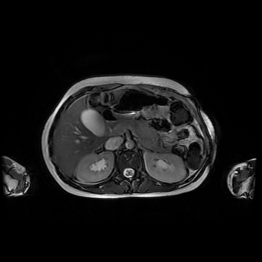 File:Normal MRI abdomen in pregnancy (Radiopaedia 88001-104541 Axial Gradient Echo 15).jpg