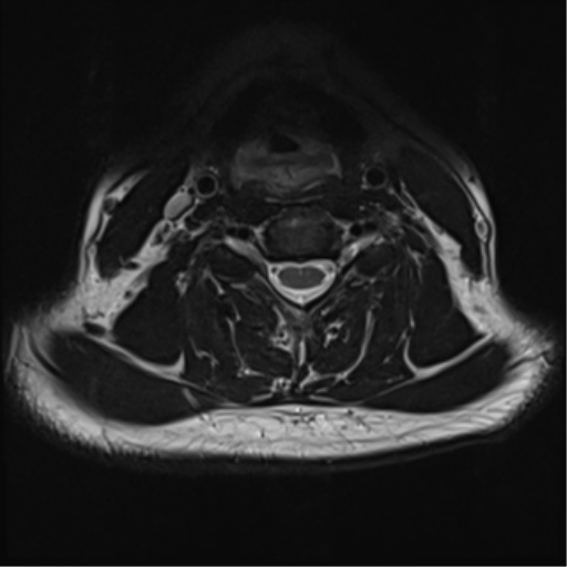 File:Normal MRI cervical spine (infection protocol) (Radiopaedia 53916-60039 Axial T2 30).png