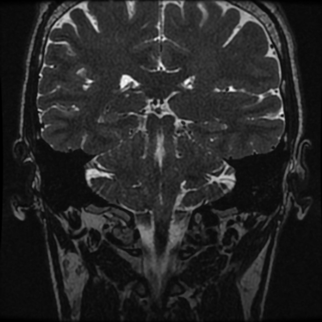 Normal MRI petrous (Radiopaedia 91317-108949 Coronal T2 75).jpg