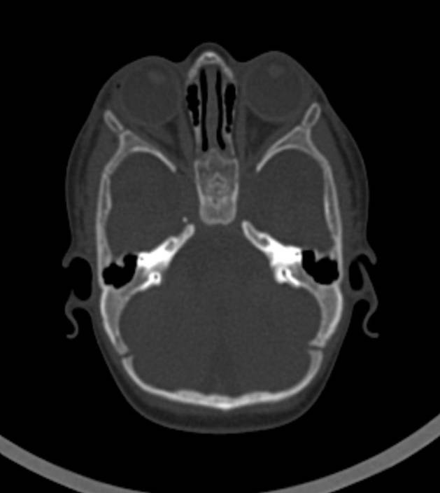 Normal brain CT - 2-month-old (Radiopaedia 53369-59350 Axial bone window 47).jpg