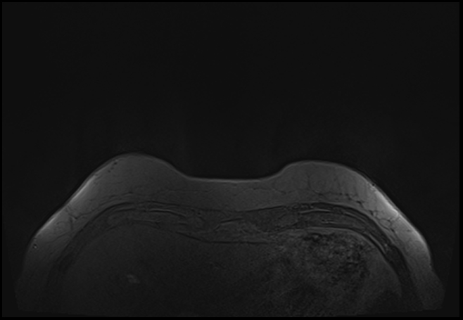 File:Normal breast MRI - dense breasts (Radiopaedia 80454-93850 Axial T1 10).jpg