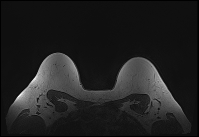 File:Normal breast MRI - dense breasts (Radiopaedia 80454-93850 Axial T1 193).jpg