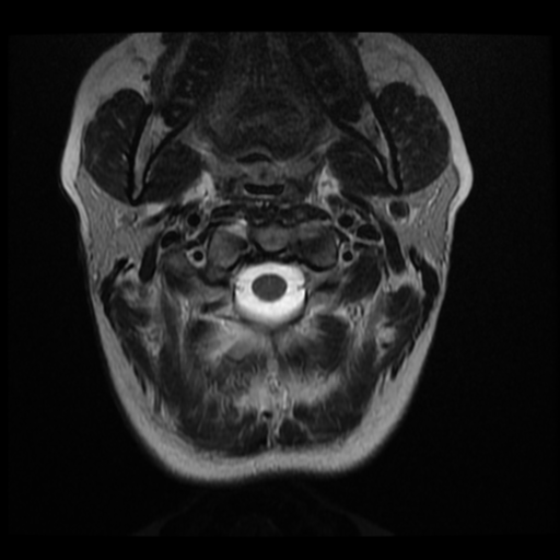 File:Normal cervical and thoracic spine MRI (Radiopaedia 35630-37156 Axial T2 30).png