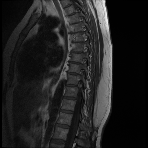 File:Normal cervical and thoracic spine MRI (Radiopaedia 35630-37156 I 5).png